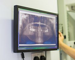 Digital dental x-rays on computer screen