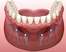 An implant-retained denture.