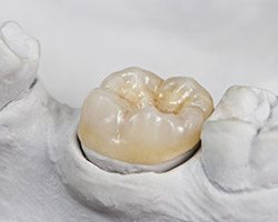 Model smile with dental crown restoration