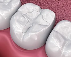 Animation of tooth-colored filling placement
