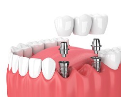 Model of an implant-retained bridge