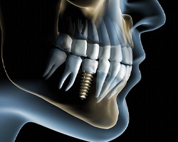 Computer image of an implant in the lower jaw