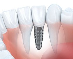 Animation of implant supported dental crown