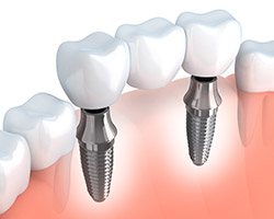 Animation of implant supported fixed bridge