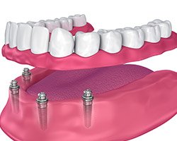 Animation of implant supported denture