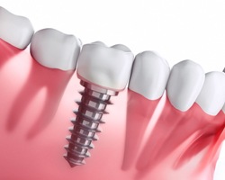 dental implant