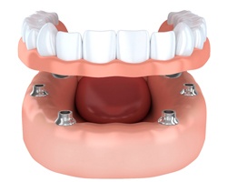 implant-retained dentures