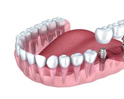 implant-retained bridge