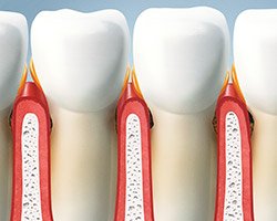 Animation of damaged gum tissue