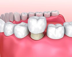 Animation of dental crown placement