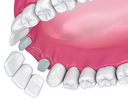 Animation of dental bridge placement