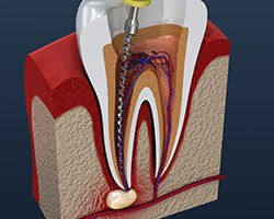 Animation of root canal treatment