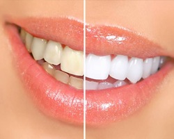 teeth whitening