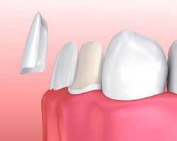 diagram of a veneer being placed on a tooth
