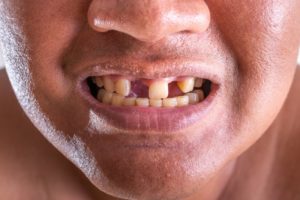 man with missing teeth 